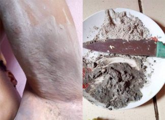 Comment effacer les vergetures sur notre peau