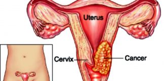 Cancer du col de l’utérus : 40% de taux de prévalence au Cameroun