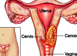 Cancer du col de l’utérus : 40% de taux de prévalence au Cameroun