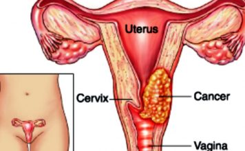 Cancer du col de l’utérus : 40% de taux de prévalence au Cameroun