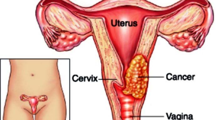 Cancer du col de l’utérus : 40% de taux de prévalence au Cameroun